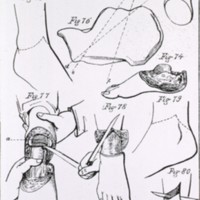 Foot Amputation Civil War.jpg